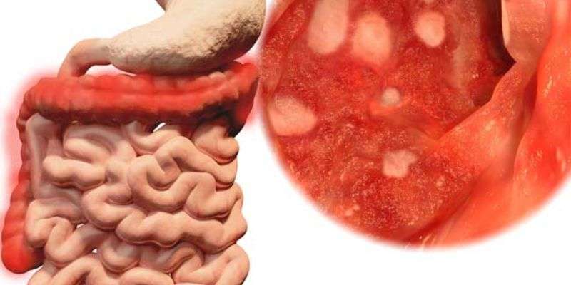 colon inflamado imagen real